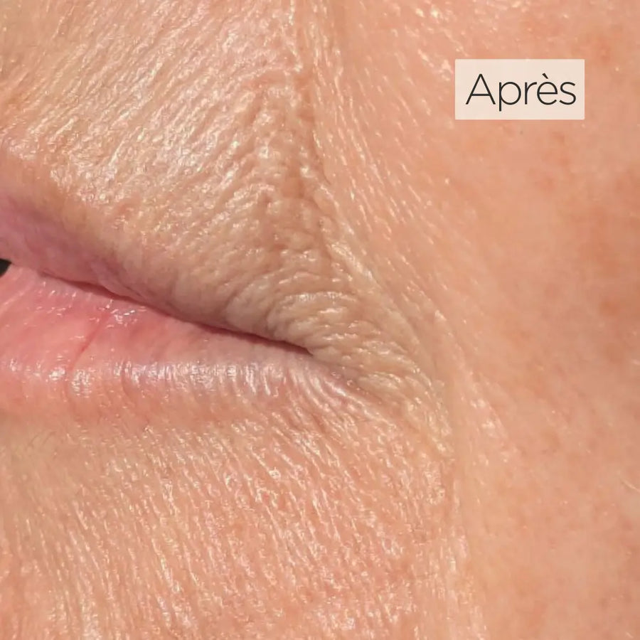 Résultats avant après du masque LED Holiaē RĒ:GEN I, montrant une peau visiblement plus lisse et une fermeté renforcée après plusieurs séances de luminothérapie rouge et infrarouge.