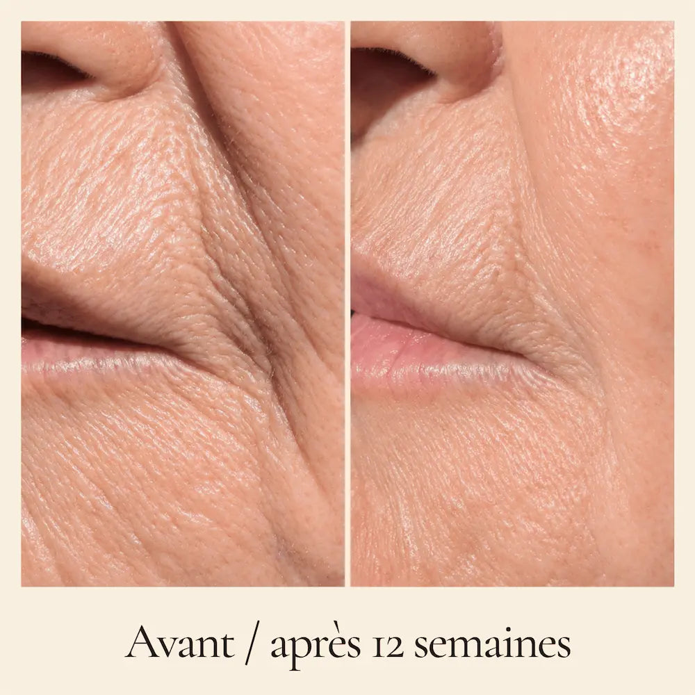 Comparatif avant après 12 semaines de la zone autour de la bouche avec RĒ:GEN I