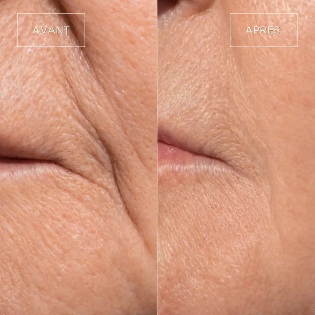 Avant après masque LED visage amélioration visible des rides et du grain de peau